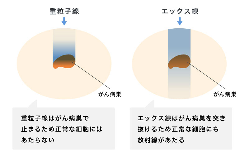 重粒子線治療とエックス線治療との違い